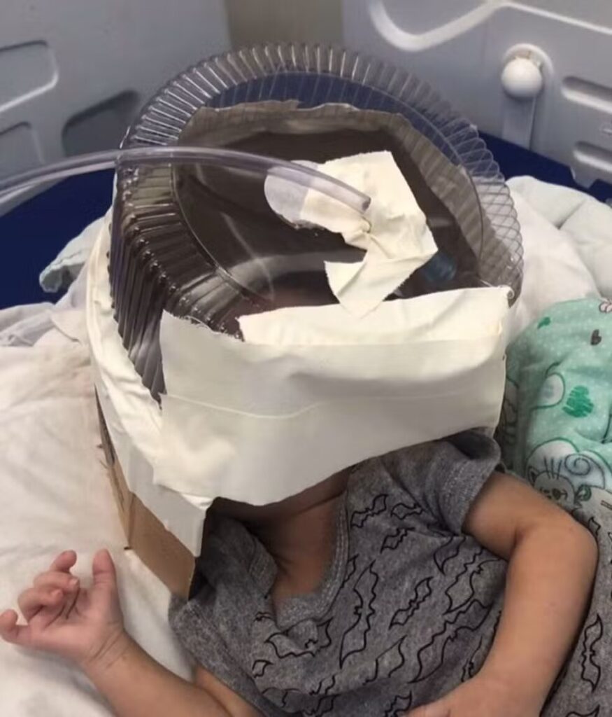 Hospital do RN usa embalagem de bolo como máscara de oxigênio para bebê de 3 meses